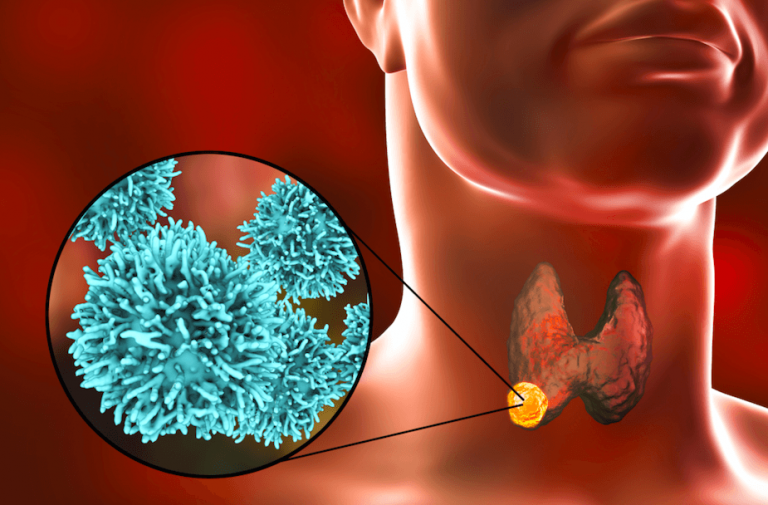 Symptômes et traitement du cancer de la thyroïde - Hisar ...