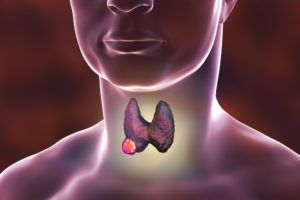 tiroid kanseri çeşitleri