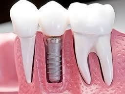 icerik oral implantoloji 1 1