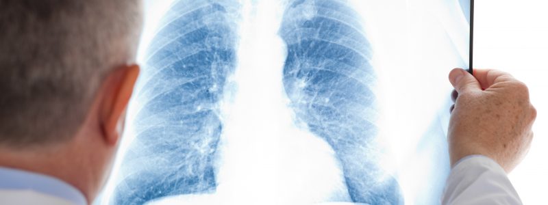 Doctor examining a lung radiography Doctor examining a lung radiography