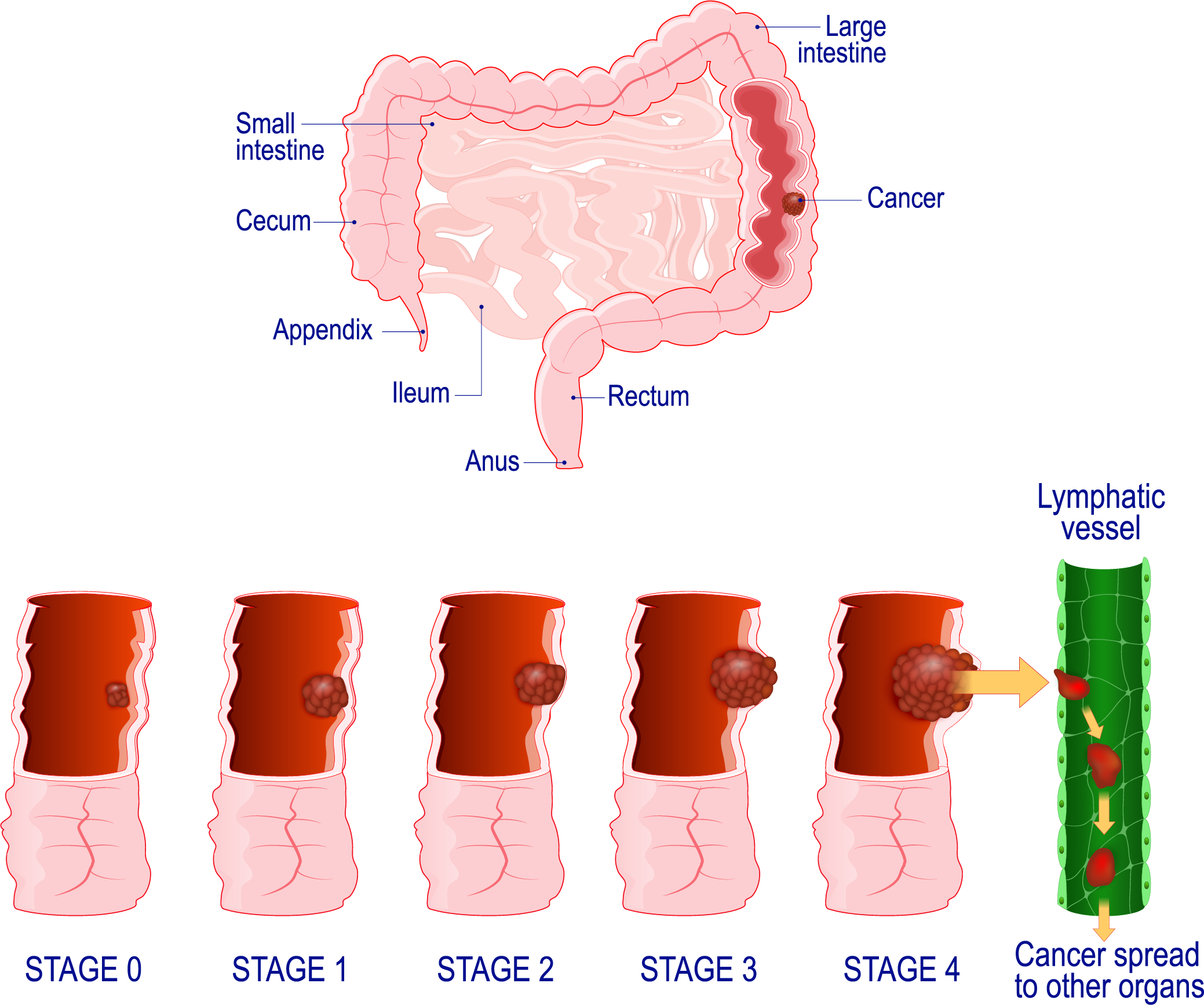 colon-cancer-hisar-intercontinental-hospital