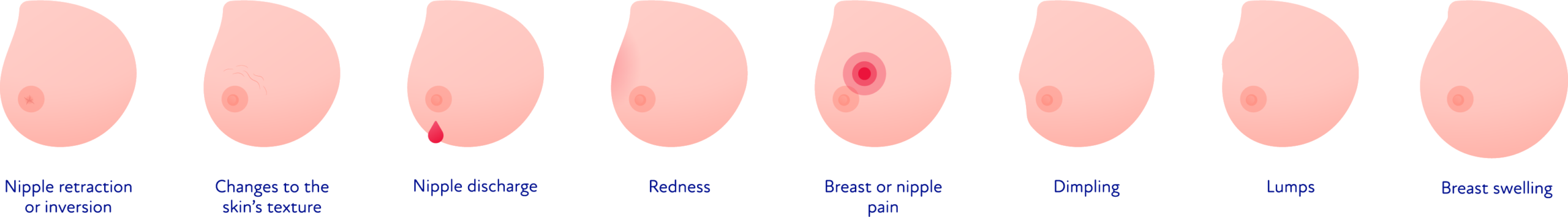 Breast Cancer 2 M Semptomlar