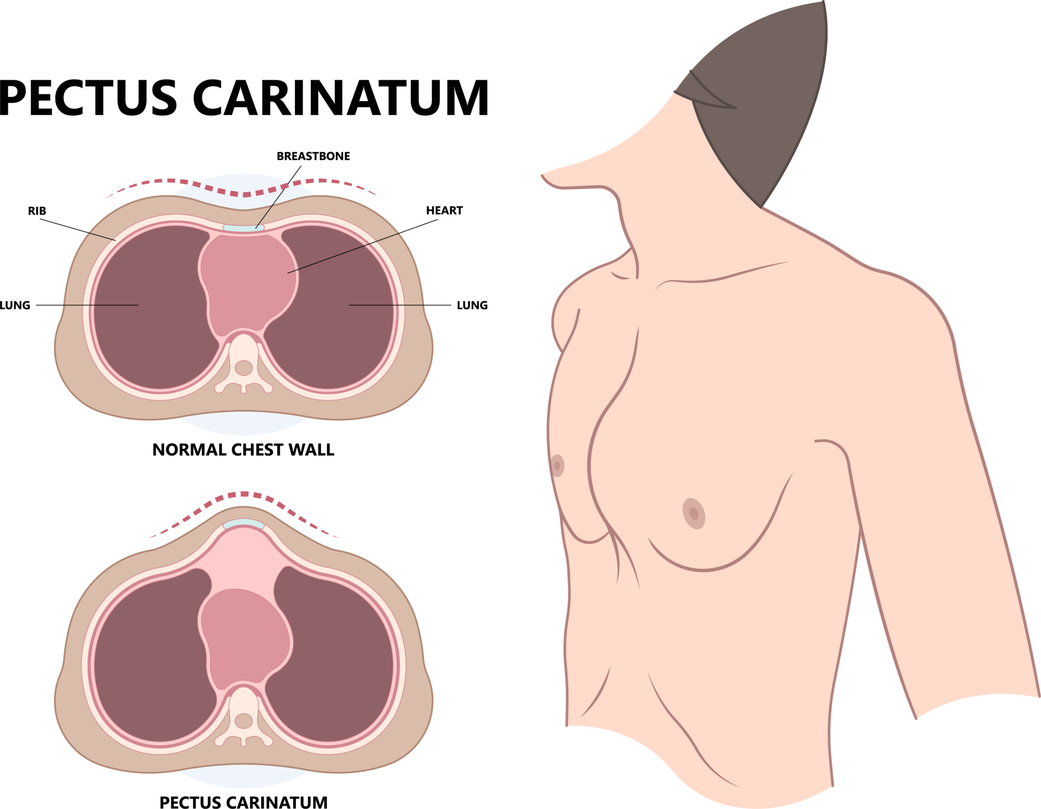 pectus-carinatum-hisar-intercontinental-hospital