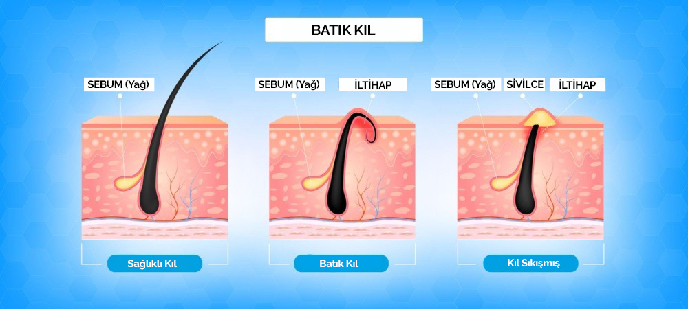 Kıl Dönmesi