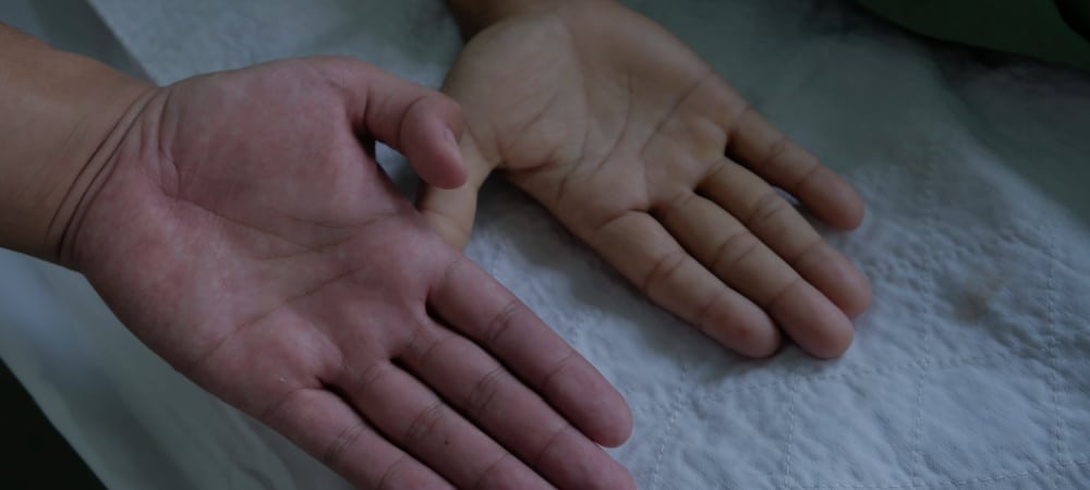 çocuklarda kansızlık ve demir eksikliği