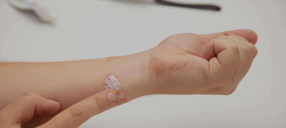 kontakt dermatit