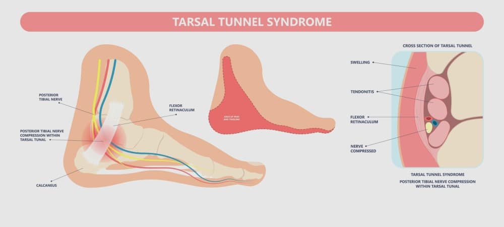 tarsal tünel sendromu