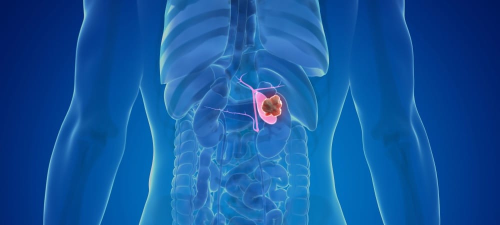 safra kesesi kanseri