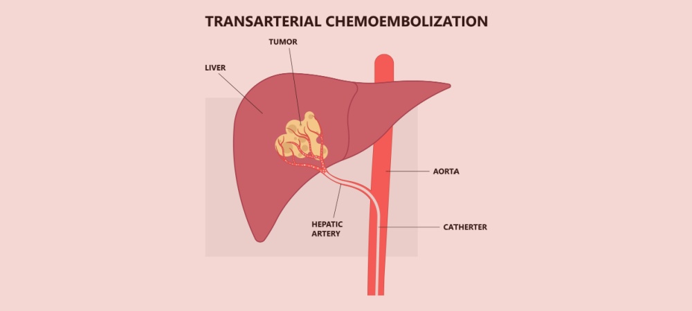 kemoembolizasyon