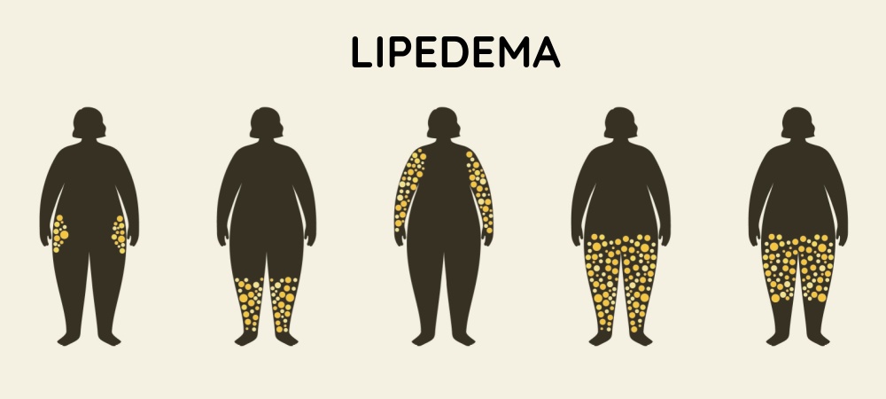 lipödem