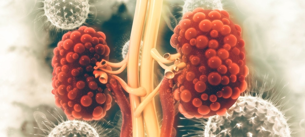 Ana Sayfa 6 Polikistik böbrek hastalığı