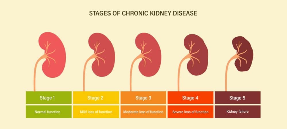 Ana Sayfa 8 kronik böbrek yetmezliği