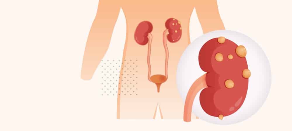 Ana Sayfa 7 İdrarda protein kaçağı