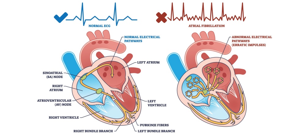 Atrial Fibrillation