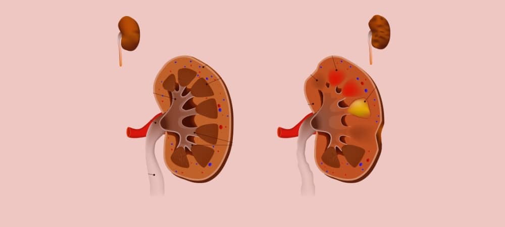 Ana Sayfa 6 böbrek iltihabı