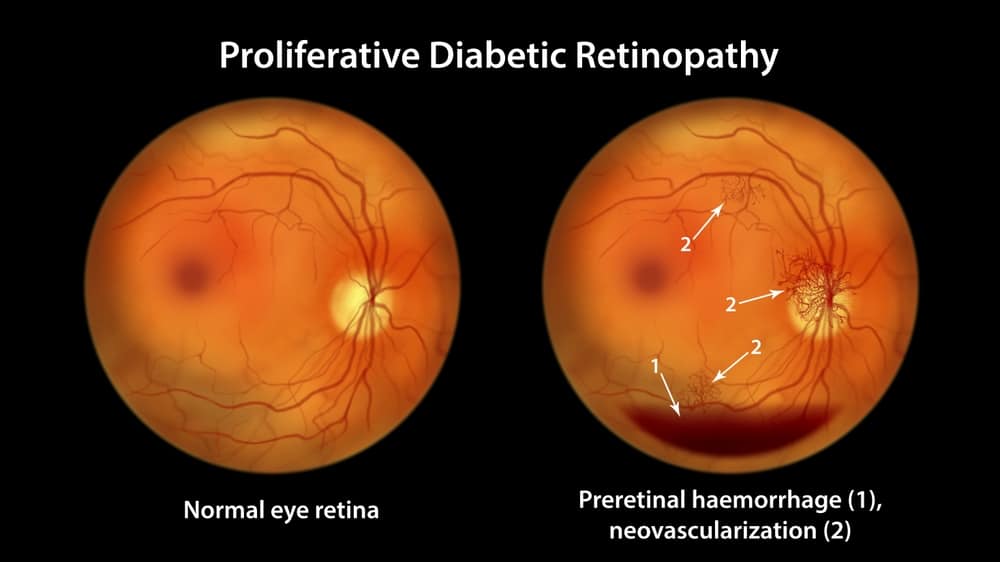 Proliferative,Diabetic,Retinopathy,,Illustration,Showing,Preretinal,Haemorrhage,As,Horizontal,Blood retina