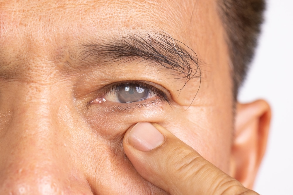 Senior,Man,Has,Cataract.,Generally,,Cataracts,Are,Common,In,Older katarakt