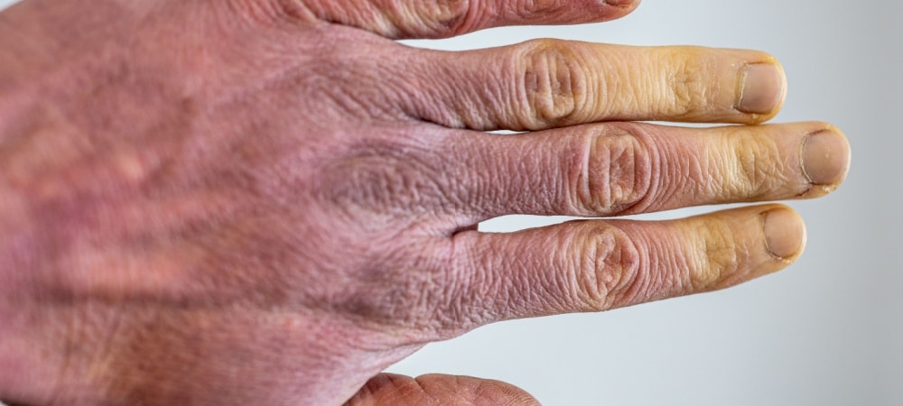 Raynaud Sendromu