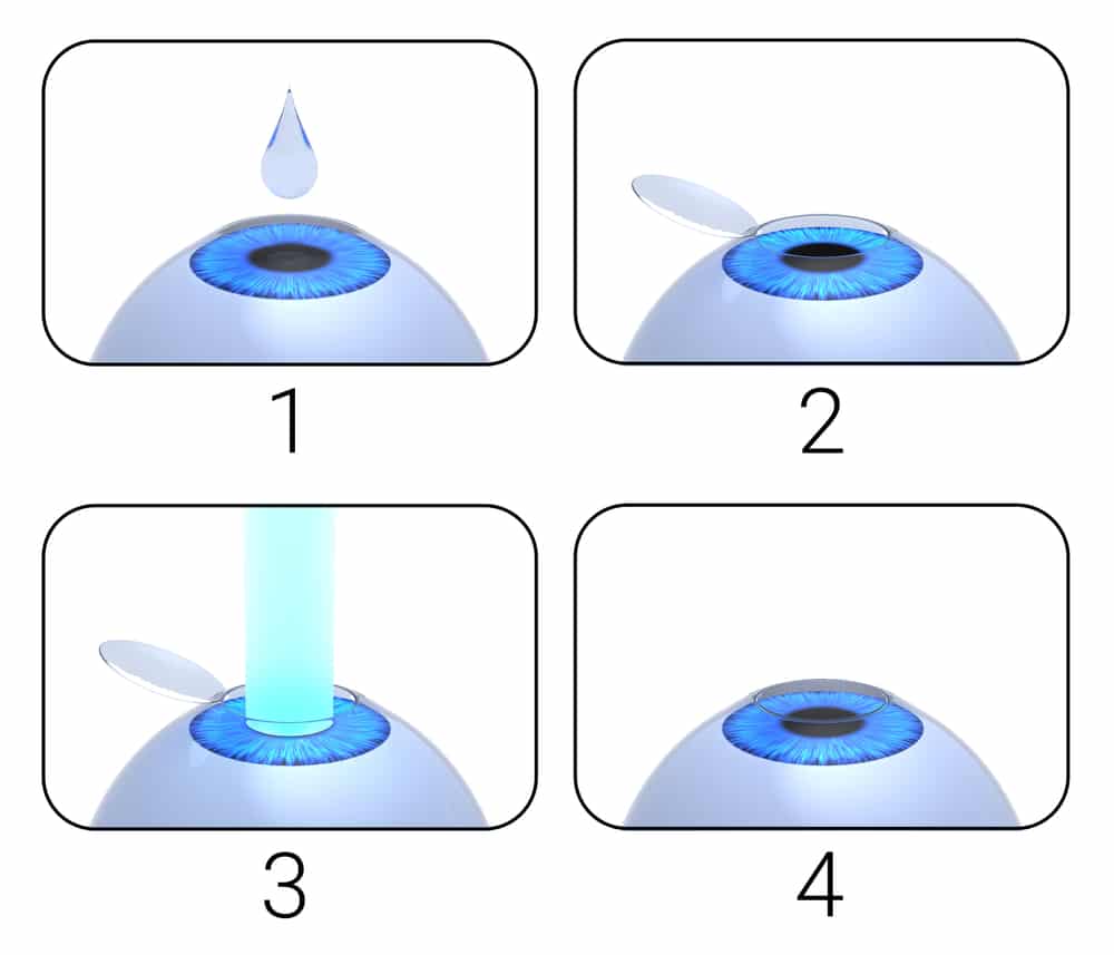 Laser,Eye,Surgery,Procedure.,3d-rendering. shutterstock 1722024328